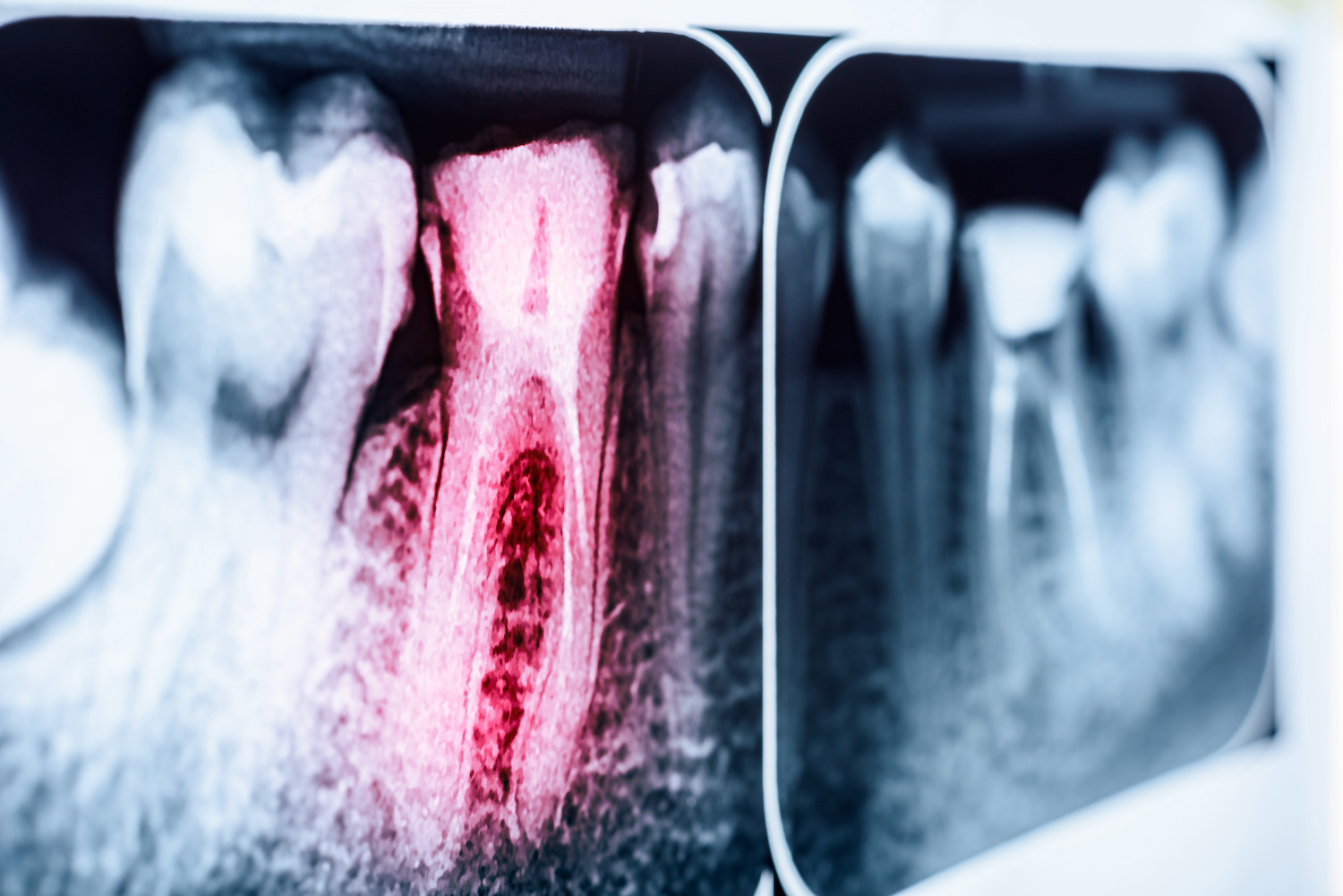 Root canal in an x-ray